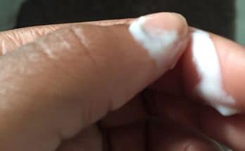 White discharge on finger 2